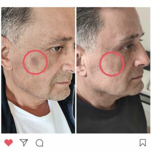 Pigment spots