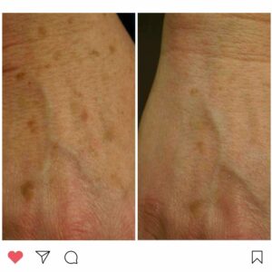 Age spots